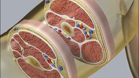 Peripheral IV ultrasound guided [NEJM]