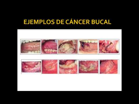 Vídeo: ¿Qué Aspecto Tiene El Cáncer De Boca? 5 Fotos De Cáncer De Boca