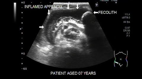 Ultrasound Video showing Inflamed appendix with faecolith in its interior.