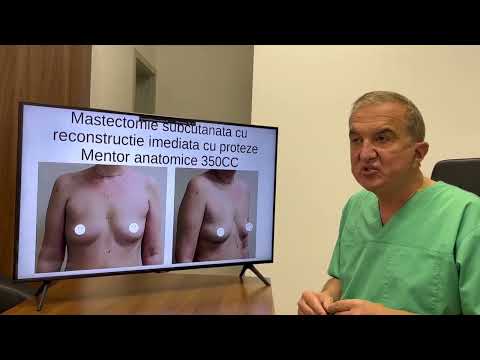 Mastectomie subcutanata cu reconstrucție imediata cu proteze Mentor anatomice 350CC