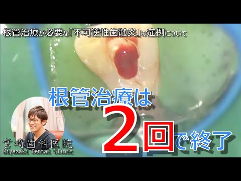 きがるな根管処置法   PARTー2 当院の根管治療
