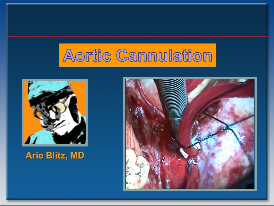How To Cannulate the Aorta for Cardiopulmonary Bypass Arie Blitz, MD