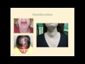 Hypothyroidism - CRASH! Medical Review Series