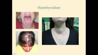 Hypothyroidism  CRASH! Medical Review Series