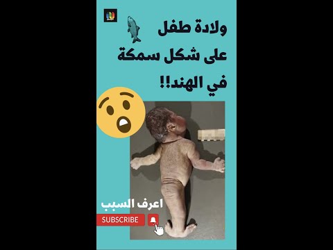 ولادة طفل على شكل سمكة في الهند اعرف السبب
