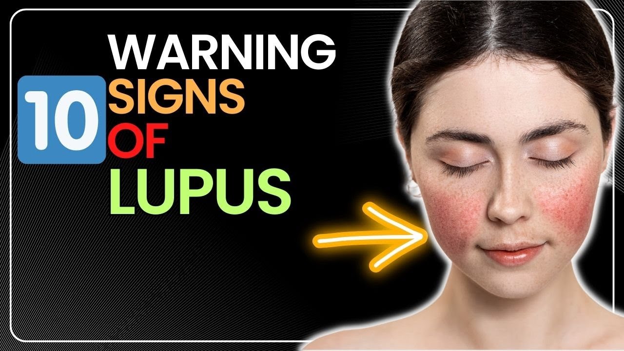 10 Warning Signs Of Lupus YouTube