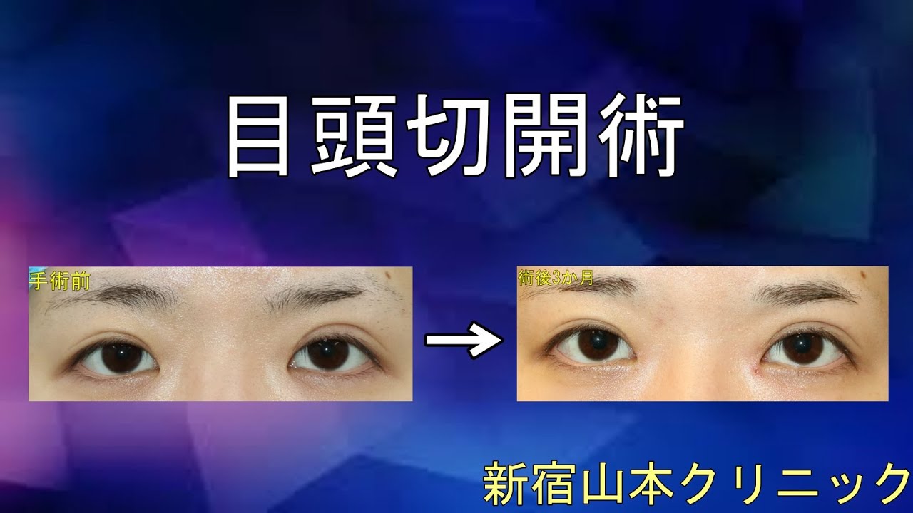 目頭切開 変わった 変わらない 目頭切開術の変化 目の手術 目頭切開 東京新宿の山本クリニック 目頭切開 変わった 変わらない 目頭切開術の変化 目の手術 目頭切開 東京新宿の山本クリニック