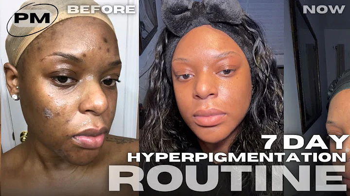 HOW I CLEARED MY HYPERPIGMENTATION & DARK MARKS IN A WEEK (NIGHTTIME ROUTINE)