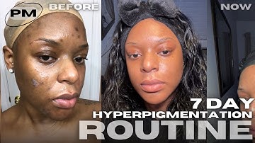 HOW I CLEARED MY HYPERPIGMENTATION & DARK MARKS IN A WEEK (NIGHTTIME ROUTINE)