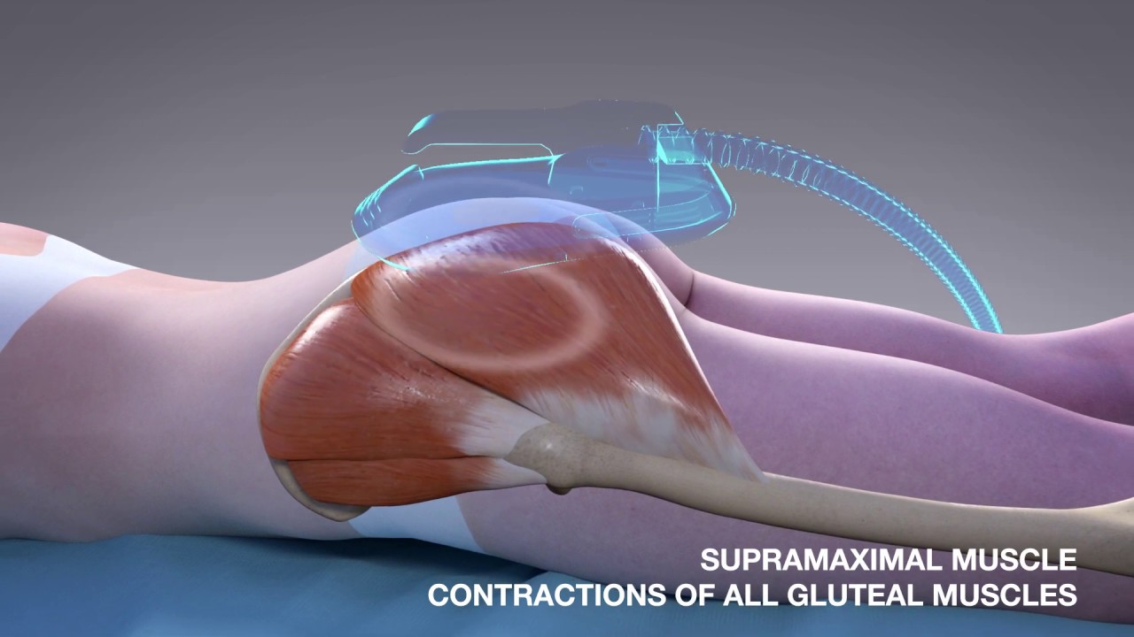 Get Toned Glutes with Emsculpt YouTube