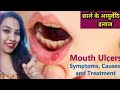 what is ulcer? क्या आप भी पूरा कारण जाने बिना करते है छालो का इलाज? जानिए क्या है कारण और निवारण।