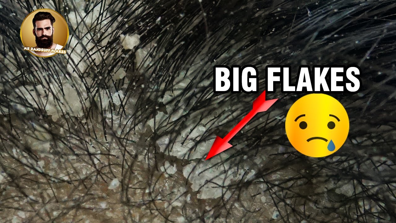 Remove Dandruff Flakes From Hair At Home 011 YouTube