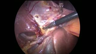Laparoscopic Cholecystectomy with accessory Cystic Duct HD Video