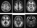 Injuria Cerebral y Neurodesarrollo Neonatal