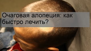 Очаговая алопеция: как быстро лечить?