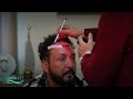 Hair transplant turkey  hairextrem hair clinic istanbul