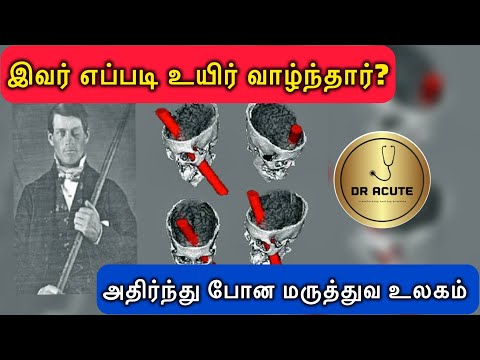 மருத்துவ வரலாற்றில் நடந்த 3 நம்ப முடியாத சம்பவங்கள் | Strange Medical History |  Tamil | Dr Acute |
