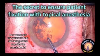 What is the secret to patient fixation during cataract surgery with topical anesthesia?