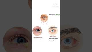 Pink Eye, Viral Conjunctivitis Disease || Pink eye symptoms #pinkeyes