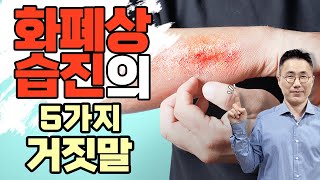 ✅화폐상습진의 5가지 거짓말✅ 유전, 독소배출, 소금물, 세균감염, 일광욕 2차감염 체액순환 정체