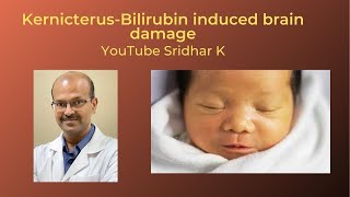 Kernicterus and BIND (bilirubin induced neurologic damage). Dr Sridhar K