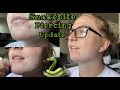 Snakebite Piercing Update