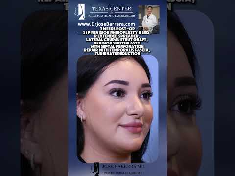 Video thumbnail: Before & after images of a 25-year-old female, 3 weeks post-op following Revision Rhinoplasty · Dr. Jose Barrera