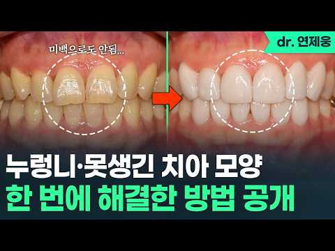 変色した前歯へのバイオニックラミネートの症例紹介（韓国語音声）