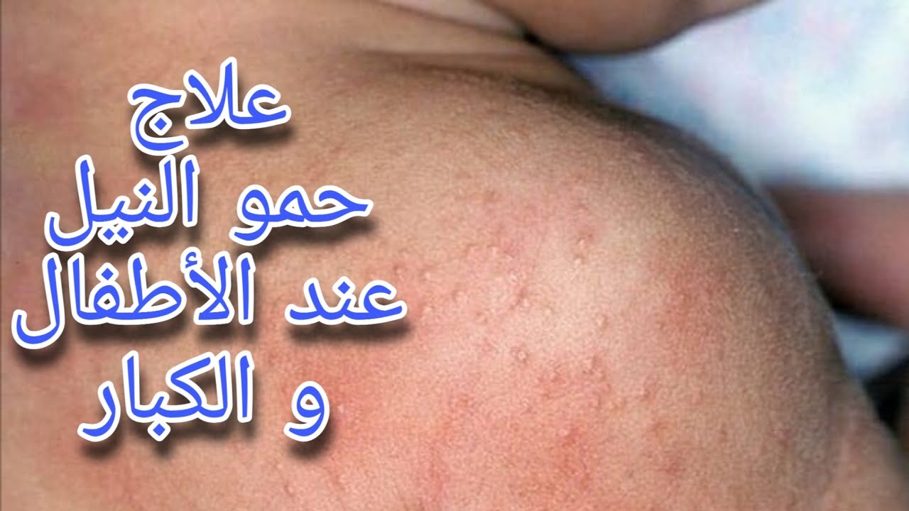 أفضل طريقة لعلاج #حمو_النيل عند الأطفال و الكبار heat rash - YouTube