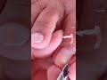 wow!pulling big ingrown😱 #ingrown_toenail #pedicure #satisfying