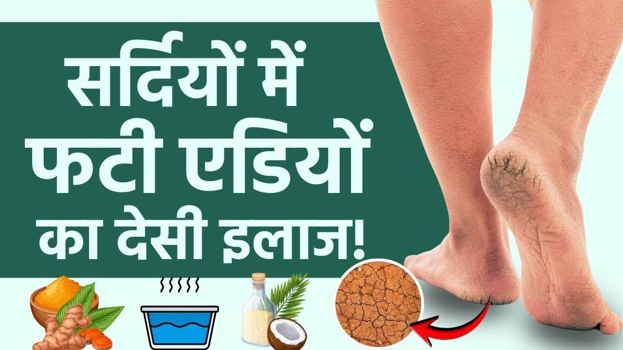 Crack Heel Home Remedies: फटी एडियों से छुटकारा पाने का देसी इलाज