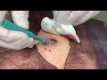 粉瘤くりぬき法 60代男性背中epidermal cyst atheroma cystic acne extractions lipoma大阪心斎橋 大阪梅田院 名古屋院 福岡院