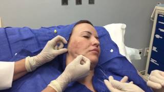 Silhouette InstaLift Procedure with Dr. Butterwick