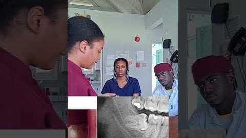 The Case of AB by Anamia Cumberbatch(400006750)  (Radiology Assignment, Impacted 3rd Molars)