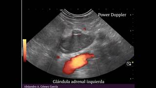 Detección temprana de Trombo vFA Glándula Adrenal Izquierda
