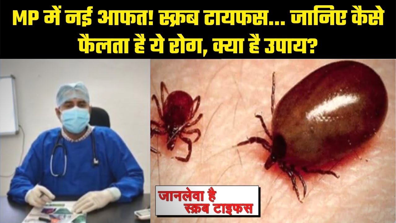 ⁣MP में नई आफत! Scrub Typhus से 2 की मौत, जानिए क्या है इस बीमारी के लक्षण, क्या है उपाय?