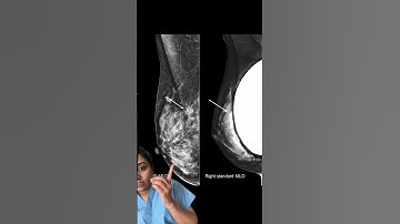 Can you have a mammogram with breast implants? #womenshealth #mammogram #breastcancer