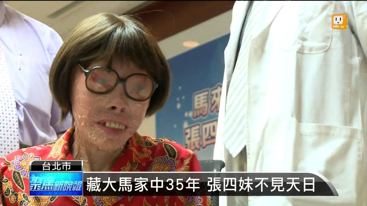 14 05 26 最長壽魚鱗癬患者張感謝台灣 Udn Tv Youtube