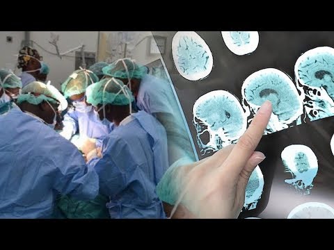 Video: Dokter Novosibirsk Mengoperasi Pasien Dengan Kelainan Otak Yang Langka