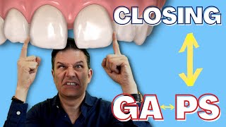 How to close spaces between teeth with clear aligners