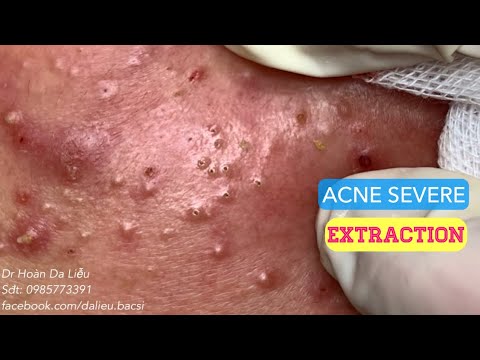 Video Mụn trứng cá mặt cực... - youtube