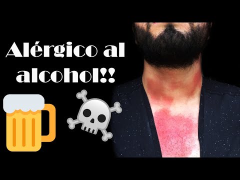 Vídeo: Alergia A La Cerveza: Síntomas, Causas Y Tratamiento