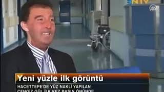 Prof. Dr. Serdar Nasir - Cengi̇z Gül Yüz Nakli̇ Haberi̇ Ntv