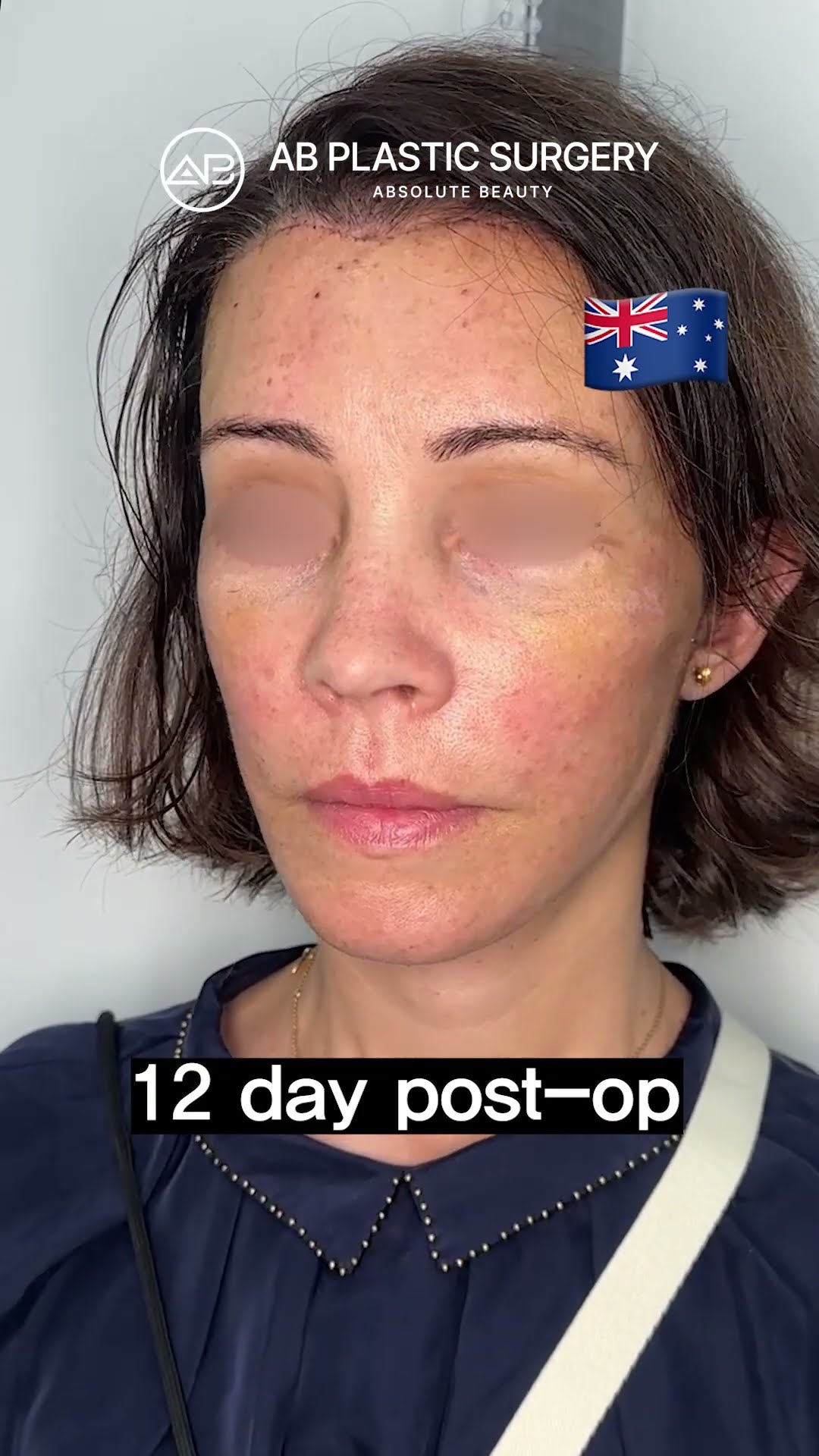 Anti-Aging Lift That Actually Works #shorts