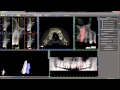 Advanced Tooth Segmentation In Blue Sky Plan