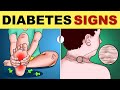 Diabetes Symptoms | Diabetes Mellitus | Type 2 Diabetes - Signs & Symptoms | Diabetes Warning Signs