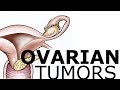 Ovarian Pathology & Tumors