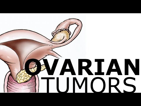 Video: Tumor Neuroektodermal Primitif Primer Ovarian: Kajian Kes Di PUMCH Dan Dalam Kesusasteraan Yang Diterbitkan