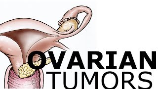 Ovarian Pathology & Tumors