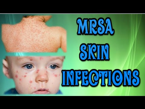 Where can you find pictures of MRSA skin infections?